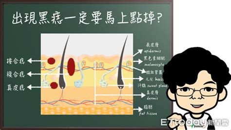 黑痣長毛